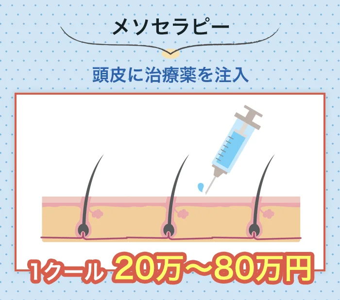 メソセラピーでAGA治療をした場合の費用目安は20～80万円
