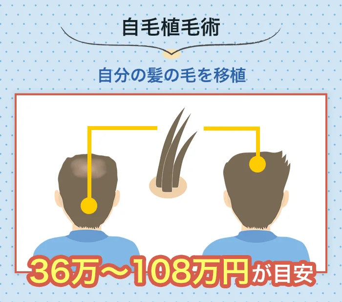 自毛植毛術でAGA治療をした場合の費用目安は36～108万円