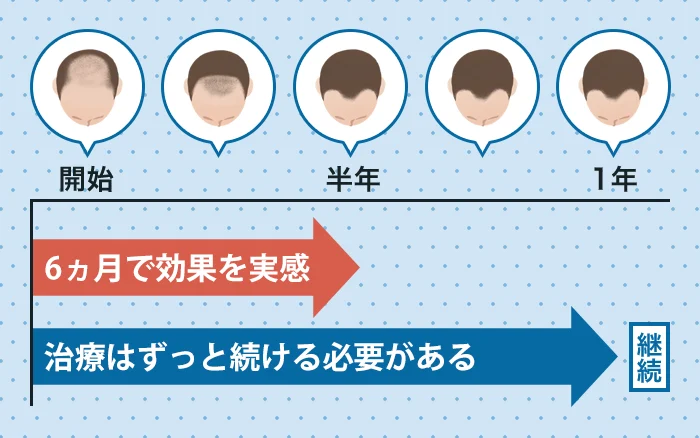 AGAの投薬治療期間と効果が出る時期の目安