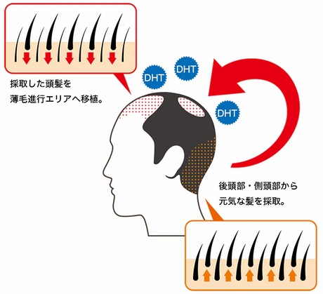 自毛植毛とは